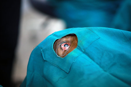 Cataract surgery.
